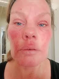 Has anyone experienced severe side effects from fludrocortisone medication  for Ehlers Danlos Syndromes?