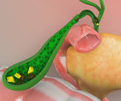 Image result for Choledocholithiasis