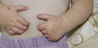 Hand Fuss Mund Krankheit Infektion Und Behandlung Herold At