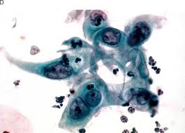 It corresponds to the area of cervix bound by the original squamocolumnar junction at the distal end and proximally by the furthest extent that squamous metaplasia has occurred as defined by the new squamocolumnar junction. The Uterine Cervix Chapter 36 Silverberg S Principles And Practice Of Surgical Pathology And Cytopathology