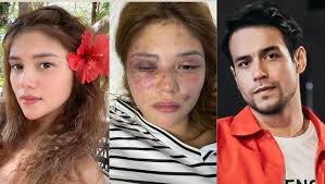 Pamilya ni Ana Jalandoni, desididong kasuhan si Kit Thompson dahil sa  umano'y pambubugbog sa aktres