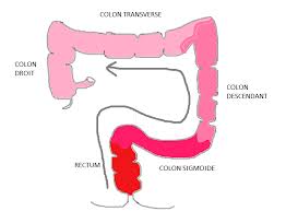 Start studying maladies diverticulaires du colon. La Rectocolite Hemorragique Snfcp