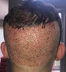 Check hair transplant before and after pictures of hair transplantation treatments; I Got A Fue Hair Transplant This Was What It Looked Like The Next Day Ama Trypophobia
