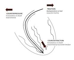 Like a pacemaker, an implantable cardioverter defibrillator, or icd, is a device placed under your skin. Intravascular Lead Extractions Tips And Tricks Intechopen