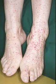 Petechiae are small red or purple dots of blood that develop on the skin or in the mucous membranes, such as in the mouth. Symptomatik Der Immunthrombozytopenie Itp