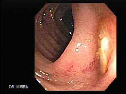 Image result for Diverticulitis