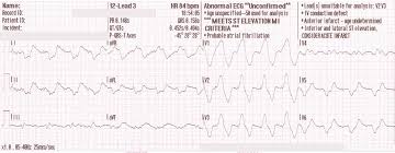 The Six Step Method For 12 Lead Ecg Interpretation Ems 12 Lead