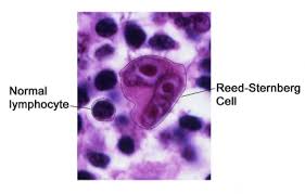 Limfoma hodgkin adalah salah satu jenis limfoma, yaitu kanker yang menyerang kelenjar getah bening (kgb). Hodgkin S Lymphoma Physiopedia