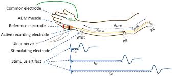 Image result for Nerve Conduction Velocity
