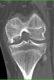 The medial condyle is one of the two projections on the lower extremity of femur, the other being the lateral condyle. Avascular Necrosis Of Medial Femoral Condyle Musculoskeletal Case Studies Ctisus Ct Scanning