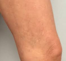 Venous Insufficiency Pictures Images A Visual Guide