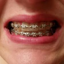 Cuando se trata de elegir el color de brackets para hombres hay que tener en cuenta de que hay gustos muy variados y aunque normalmente los hombres suelan preferir diseños y colores sencillos, hay algunos que prefieren colores más alegres o arriesgarse con diferentes combinaciones. Pin En Orthodontic Headgear