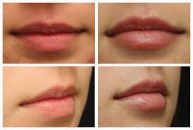 Ice the lips on and off for an additional hour or so. Demystifying Lip Injections Here S The Do S Don Ts For The Perfectpout The Retreat Medical Spa