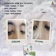 Adakah glowwegirls dan glowweguys memiliki milia? Titis 100 Original Ubat Kutil Biji Kolestrol Lazada