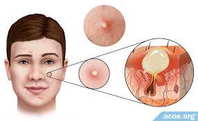 Image result for Pustule