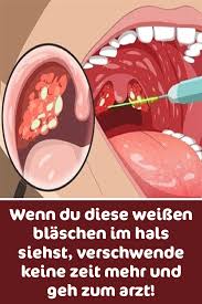 Wenn Du Diese Weissen Blaschen Im Hals Siehst Verschwende Keine Zeit Mehr Und Geh Zum Arzt Mandelentzundung Hausmittel Schluckbeschwerden Angina Hausmittel