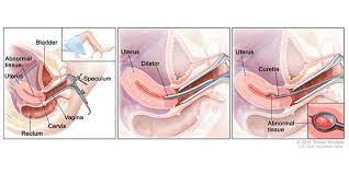 Bayangkan saja selama kita hidup telah banyak makanan dan minuman yang kita konsumsi masuk ke dalam usus. Proses Kuret Ternyata Dilakukan Seperti Ini Tidak Banyak Yang Tahu Semua Halaman Nakita