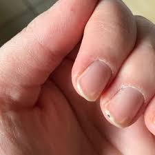 Schwarzer Fleck Am Fingernagel Was Ist Das Gesundheit Und Medizin Haut Schwarz