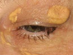 Image result for xantelasma