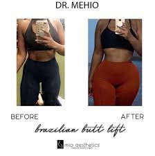 Home to sunny skies, beautiful weather, picturesque beach. Mia Aesthetics An Amazing Transformation By Dr Mehio Bbl Drmehio Miaaestheticsmiami Beforeandafter Facebook