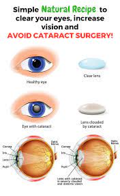 Natural Recipe To Clear The Eyes Avoid Cataract Surgery And Increase Your Vision In 3 Months Health Healt Cataract Surgery Natural Therapy Natural Remedies
