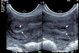 Image result for First Trimester Ultrasound