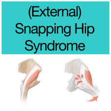 Image result for Snapping Hip