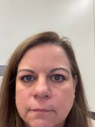 Hi, I have the Airfit F30 and lately I've been getting a red mark (broken  skin) below the bridge of my nose. Has this happened to any of you and does  anyone