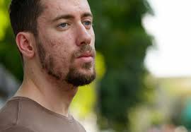 Fight the root cause with diet and exercise. When Should Men See A Dermatologist For Adult Acne Health Essentials From Cleveland Clinic