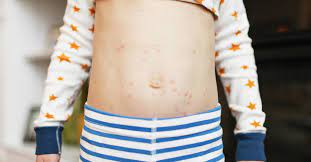 N distinguishing small pox and chicken pox lacks in the aspect of which system is affected by each of them and the severity plus damage caused and types of foods and beverages required in each. Chickenpox Diet Foods To Eat Foods To Avoid