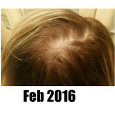 Hemoglobin is the structure that gives blood color and carries oxygen. Anemia Stress Hair Loss Ammieelou27 S Blog