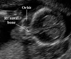 Short Nasal Bone