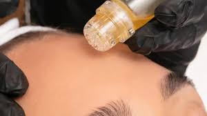 AquaGold Treatment Dubai | Finest Microneedling Gold Facial at Serenity