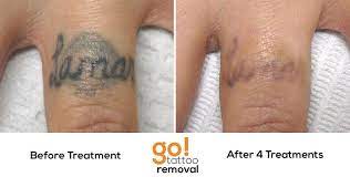 Making Solid Progress On This Finger Tattoo After 4 Laser Tattoo Removal Treatments Only A Few Left Before It S Tattoo Removal Laser Tattoo Arm Tattoo Removal