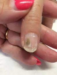 According to a 2016 review, thymol has antifungal and antibacterial properties. Is It Nail Mould Katie Barnes Explores Scratch Magazine