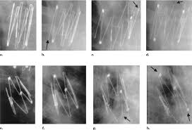 Zenith flex aaa endovascular graft, stent cook medical. 11 Year Follow Up Of Two Gianturco Z Stents Placed In The Airways Of An Infant A Prospective Analysis Of Stent Damage Journal Of Vascular And Interventional Radiology