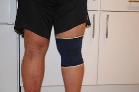 Das knie ist beim anlegen der tapes gebeugt. Knie Tapen Schmerzen Im Knie Lindern Kinesio Tape Handel
