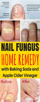 Vinegar contains acetic acid which actively kills many types of mycolic bacteria and fungus. Krobknea Nail Fungus Home Remedy Baking Soda Apple Cider Vinegar