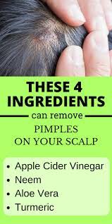 How To Get Rid Of Pimples On The Scalp Pimples Scalp Acne Acnetreatments Acnetips Pimples On Scalp How To Get Rid Of Pimples Scalp Acne