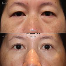 This beautiful patient is loving her lighter and brighter look 4 months  after Upper and Lower Blepharoplasty! I performed this customized  #blepharoplasty with fat repositioning, a chemical peel, and  epicanthoplasty, which removes