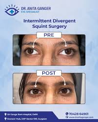 Image result for Eye Deviation