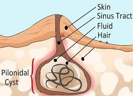Find symptoms,causes and treatments of pilonidal cyst. Pilonidal Sinus Clinical Features Management Teachmesurgery
