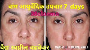 Treatment for melasma on face. à¤µ à¤— à¤µà¤° à¤˜à¤°à¤— à¤¤ à¤‰à¤ª à¤¯ à¤®à¤° à¤  Melasma Pigmentation Ayurvedic Treatment Vang Upay Marathi Youtube