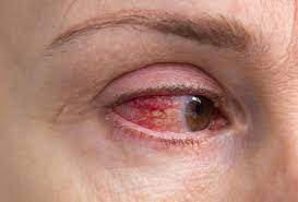 Ocular Complications Develop In Ra Connective Tissue Disease Vasculitis Patients Latest News For Doctors Nurses And Pharmacists Rheumatology