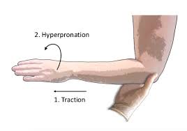 Image result for Radial Head Dislocation