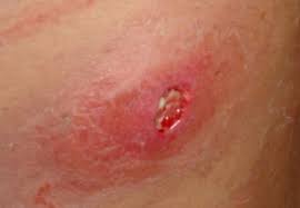 They are always painless unless they get infected. Ingrown Armpit Hair That Is Infected Ingrown Hair Ingrown Hair Remedies Ingrown Hair Scar