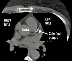 We are providing the best quality of it. When You Look For Cancer You Might Find Heart Disease Harvard Health