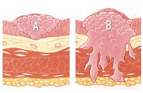 Blood in the urine or hematuria is the most common, and often the first, sign of bladder cancer. Healthy Viewpoints