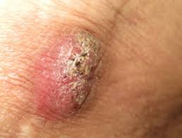 Once nodules or granulomas develop, steroid injections, massage, saline infiltration, or surgical excision are all options. Foreign Body Granuloma Dermnet Nz