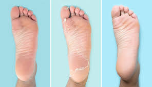 What is a 'normal' foot? Baby Foot Peel Reviews Dupes And What To Know Before You Try It Self